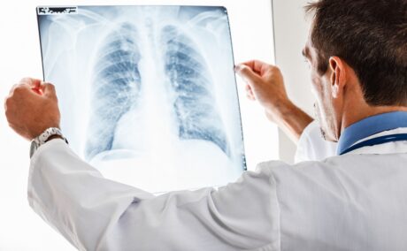 Medic care examineaza o radiografie pulmonara pentru pneumonie