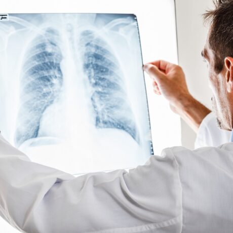 Medic care examineaza o radiografie pulmonara pentru pneumonie