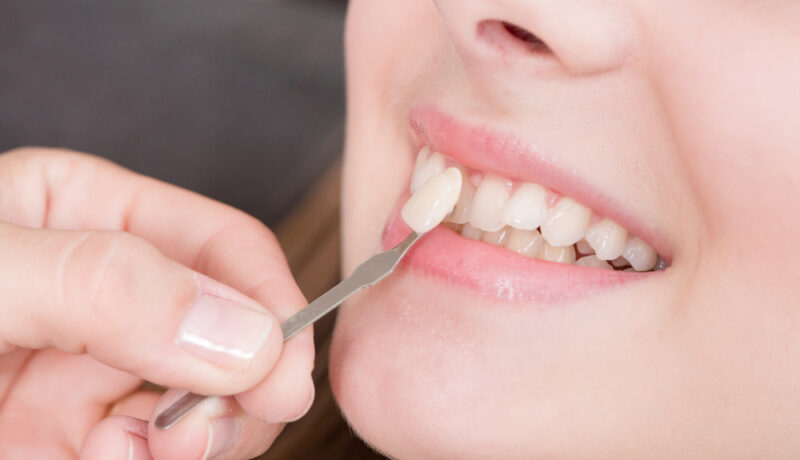 Totul despre fațetele dentare: tipuri și îngrijire