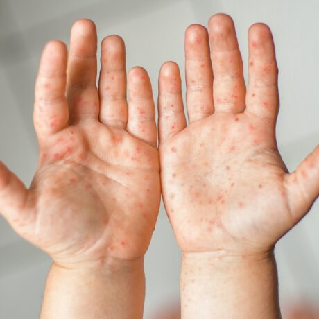 Copil cu bubițe pe ambele palme cauzate de boala gură-mână-picior