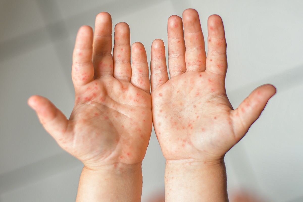 Copil cu bubițe pe ambele palme cauzate de boala gură-mână-picior