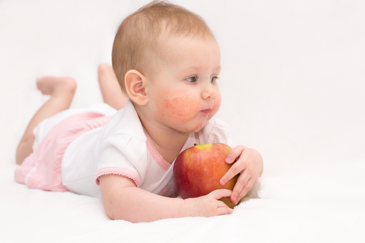 Bebeluș cu dermatită atopică pe obraji care mănâncă dintr-un măr