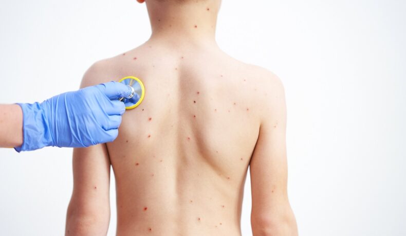 Copil cu bubițe de varicelă pe spate consultat de medic