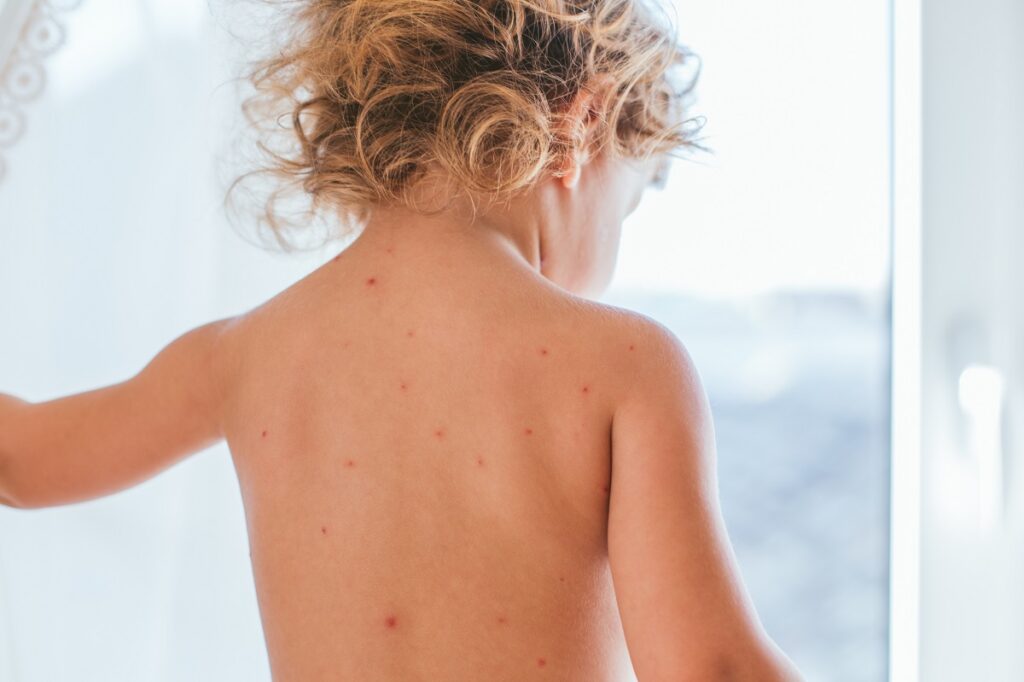 Copil cu început de varicelă - pete roșii pe corp