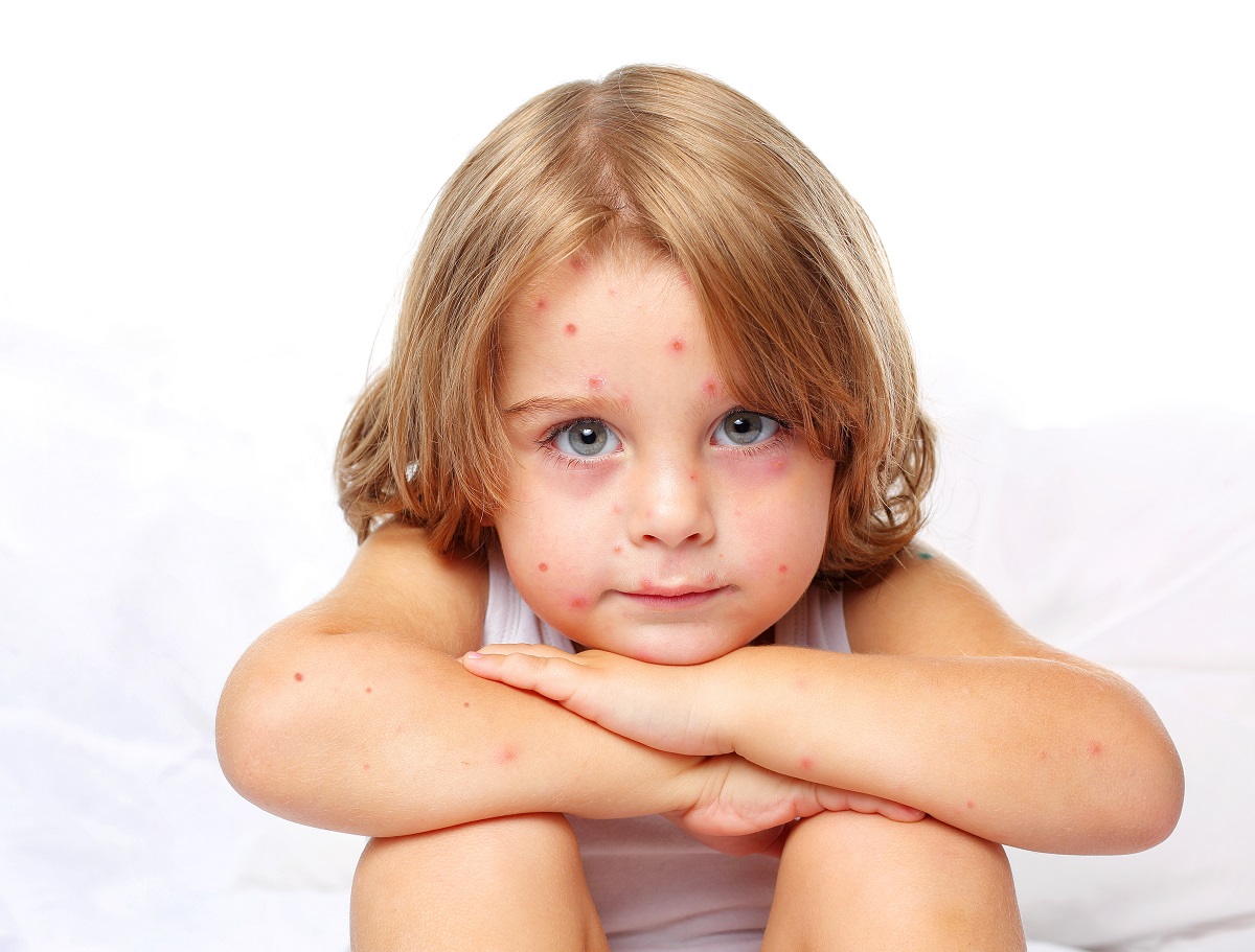 Copil cu erupție de varicelă pe față și corp, sugestiv pentru un început de varicelă
