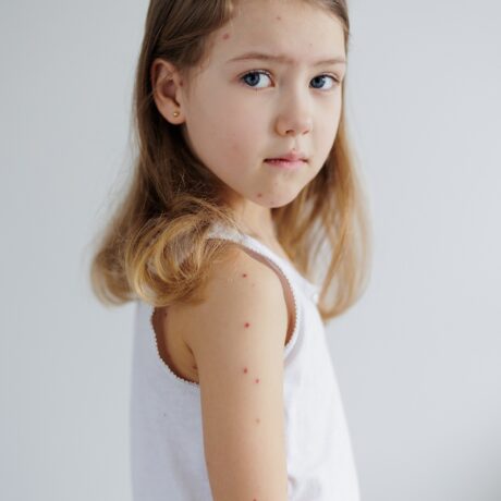 Fetiță cu formă ușoară de varicelă