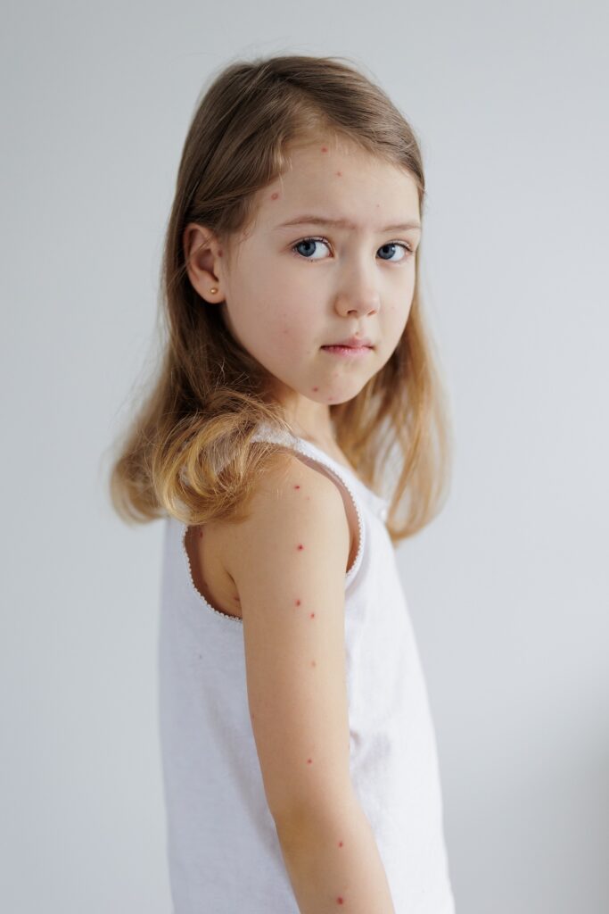 fetiță cu formă ușoară de varicelă / Shutterstock