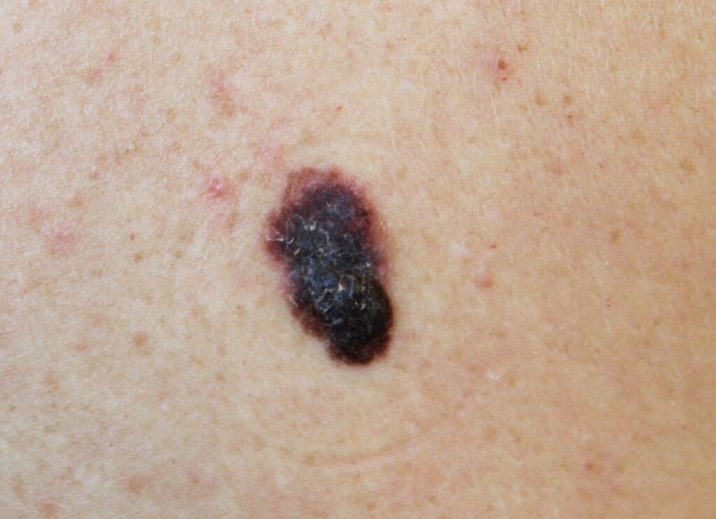 aluniță asimetrică suspectă de melanom