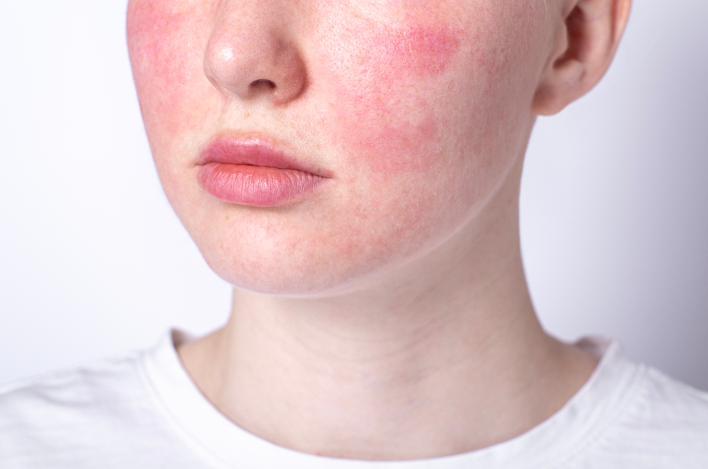 O femeie tânără cu o piele sensibilă pe față, afectată de cuperoză