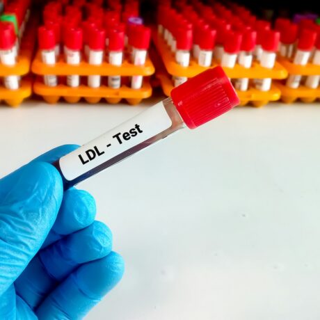 Eprubetă cu sânge și etichetă cu LDL test, una dintre analizele incluse în profilul lipidic