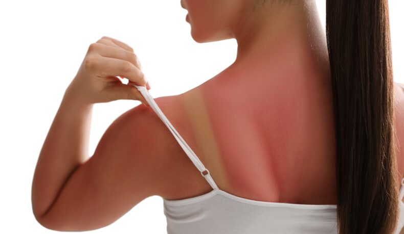 Femeie cu pielea roșie de la arsuri solare pe spate