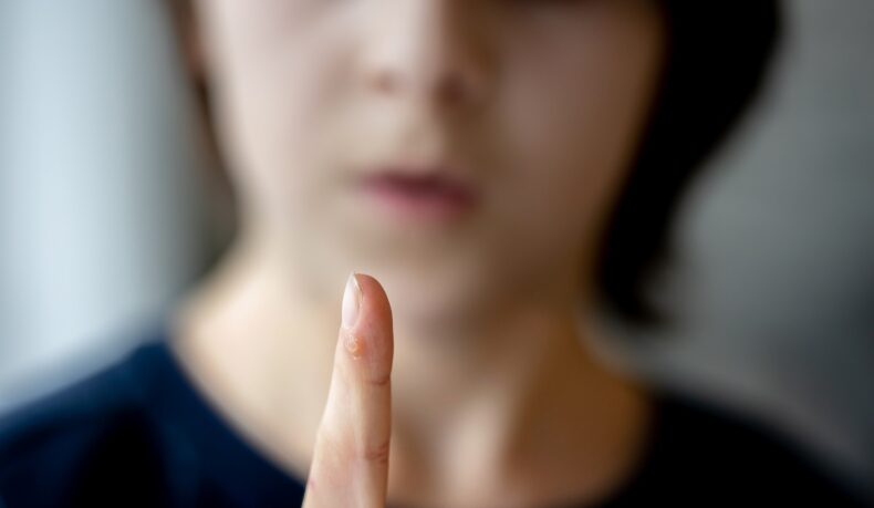 Femeie cu neg pe deget, cea mai comună formă de veruci