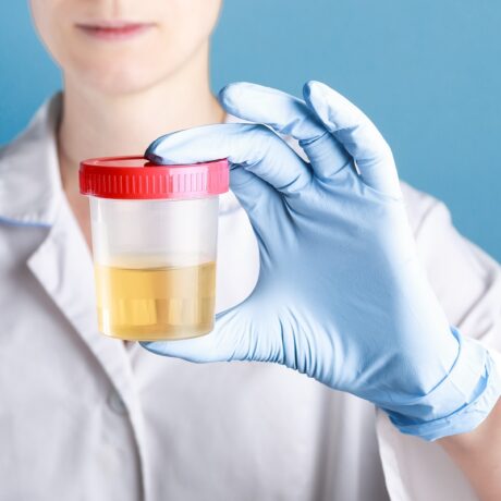 Medic care ține în mână o probă de urină, sugestiv pentru diferența dintre sumar de urină și urocultură
