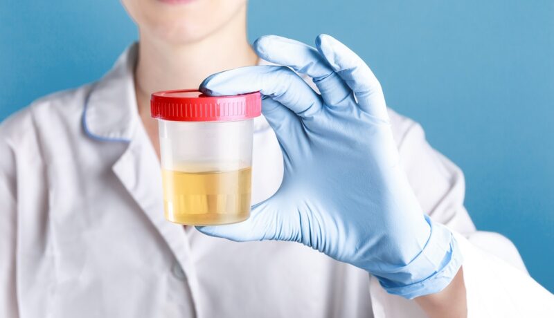 Diferența dintre sumar de urină și urocultură. Ce poate depista fiecare din ele