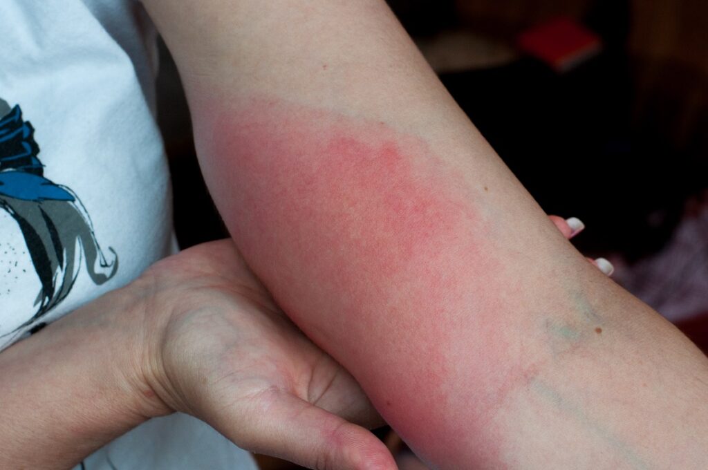 reacție alergică pe braț după o înțepătură de viespe