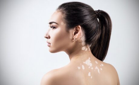 Femeie cu pete de vitiligo pe spate