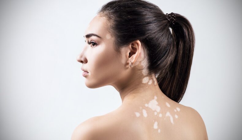 Femeie cu pete de vitiligo pe spate