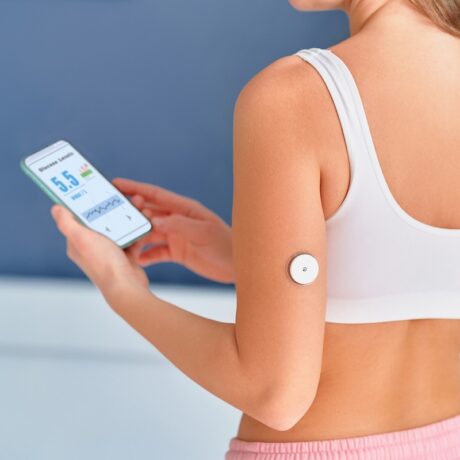 Sistemul de monitorizare continuă a glicemiei implantat pe brațul unei femei și conectat la telefonul mobil, care afișează măsurătorile