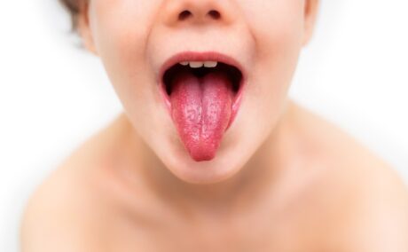Copil cu limba scoasă cu aspect de căpșună ce caracterizează scarlatina