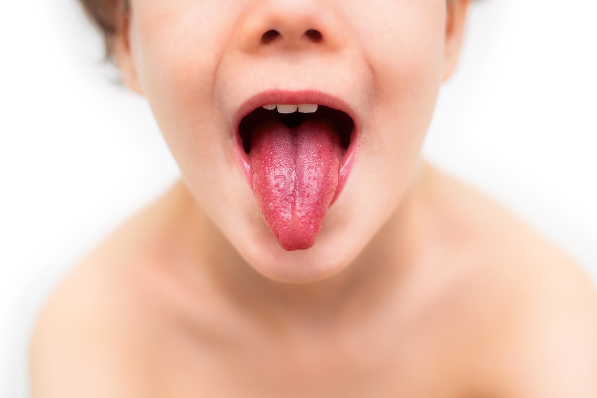 Copil cu limba scoasă cu aspect de căpșună ce caracterizează scarlatina