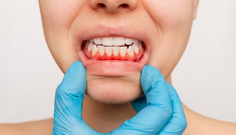 Ce este parodontoza, boala care poate duce la pierderea dinților