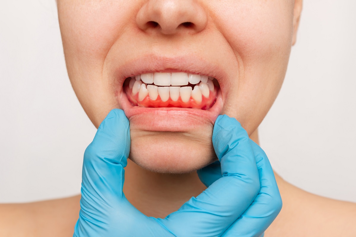 Femeie cu gingii inflamate și roșii, prima etapă care semnalează parodontoza