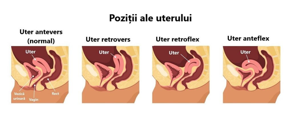 ilustrație cu uterul normal, uterul retrovers, uterul retroflex și uterul anteflex