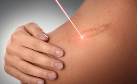 Femeie cu cicatrice pe umăr și undă laser, unul dintre tratamentele recomandate pentru cicatrici
