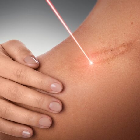 Femeie cu cicatrice pe umăr și undă laser, unul dintre tratamentele recomandate pentru cicatrici