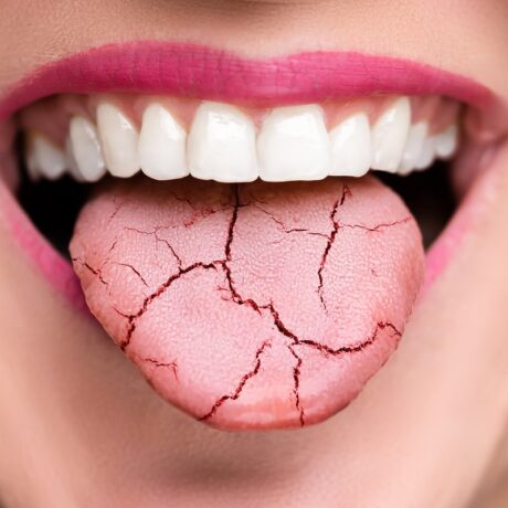 Femeie cu limba crăpată, sugestiv pentru gura uscată