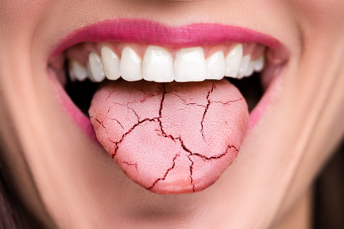 Femeie cu limba crăpată, sugestiv pentru gura uscată