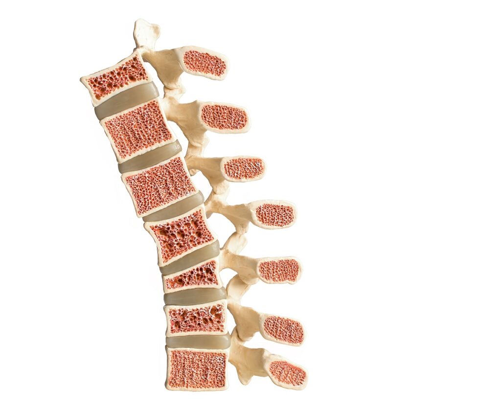 Cum arată osteoporoza: secțiune cu o coloană vertebrală cu densitate osoasă redusă