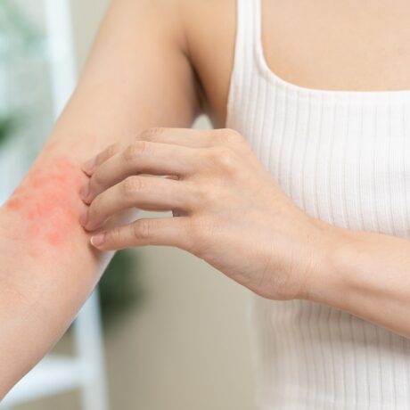 Femeie cu iritație pe un braț care se scarpină, sugestiv pentru infecțiile cu stafilococ auriu care afectează pielea