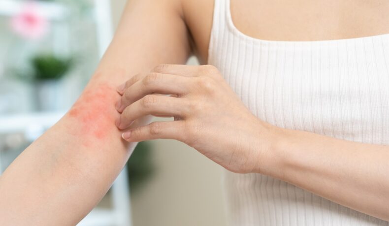Femeie cu iritație pe un braț care se scarpină, sugestiv pentru infecțiile cu stafilococ auriu care afectează pielea