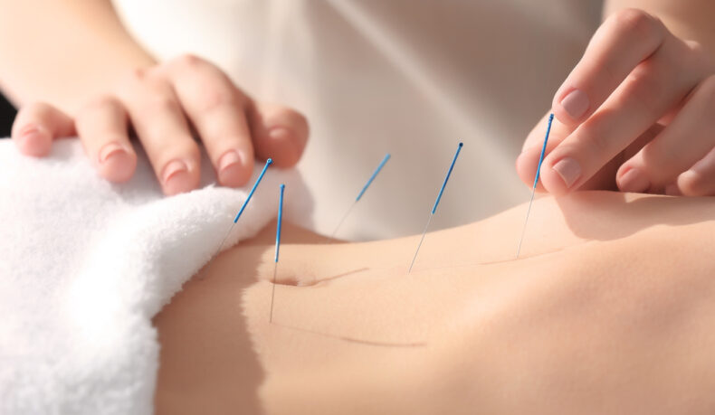 O femeie tânără primește tratament de acupunctură