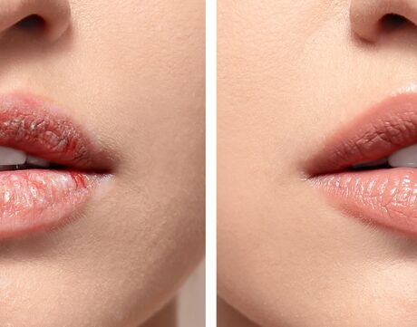 Colaj care arată evoluția unui tratamnt pentru buze uscate, în cazul unei femei tinere
