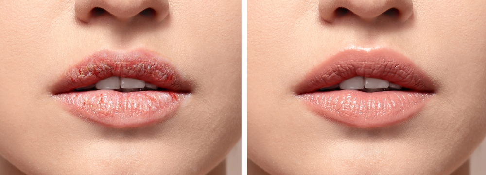 Colaj care arată evoluția unui tratamnt pentru buze uscate, în cazul unei femei tinere