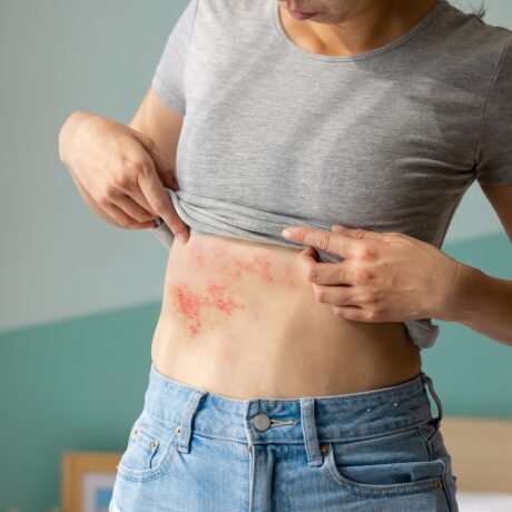 Femeie cu leziuni de zona zoster pe abdomen, sugestv pentru zona zoster - simptome și aspect