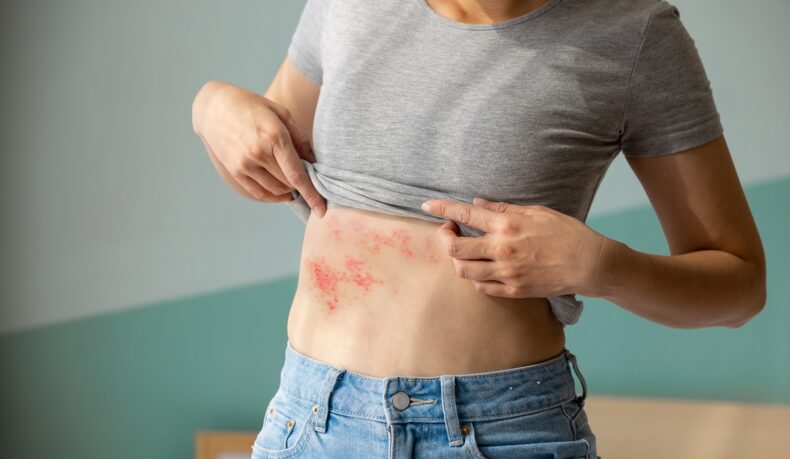 Femeie cu leziuni de zona zoster pe abdomen, sugestv pentru zona zoster - simptome și aspect