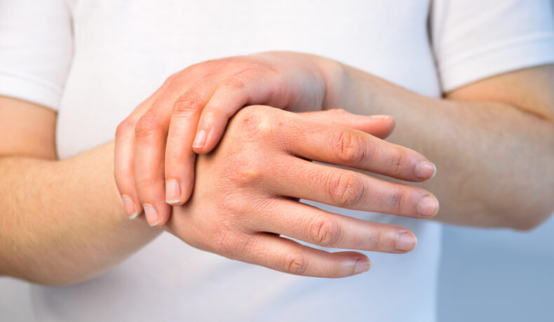 Remedii simple pentru mâini uscate. Metode prin care îți poți proteja pielea