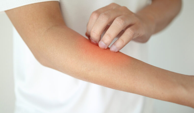 O persoană tânără se confruntă cu o iritație la nivelul pielii