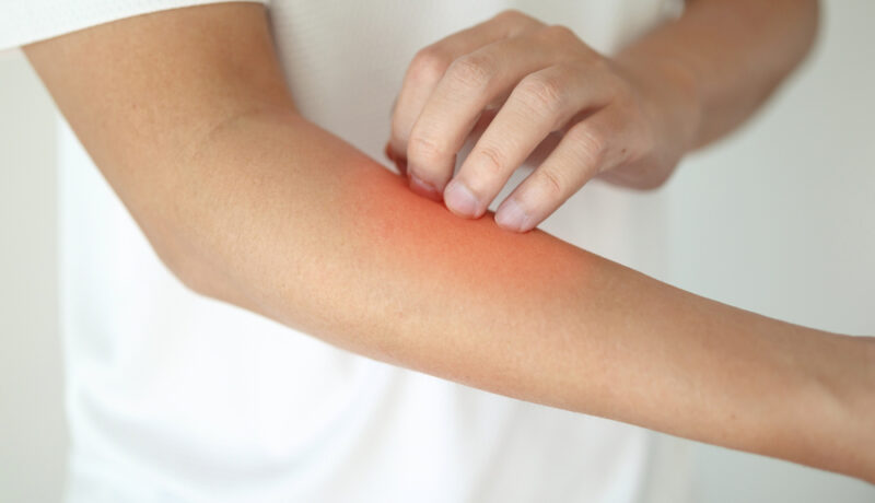 O persoană tânără se confruntă cu o iritație la nivelul pielii