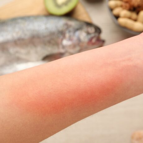 O femeie tânără își ține brațul iritat deasupra unei mese cu: pește, kiwi și arahide