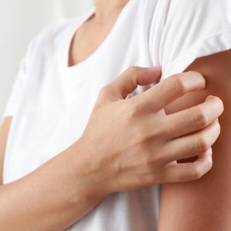 Detaliu cu femeie care se scarpină pe mână, sugestiv pentru alergia la frig