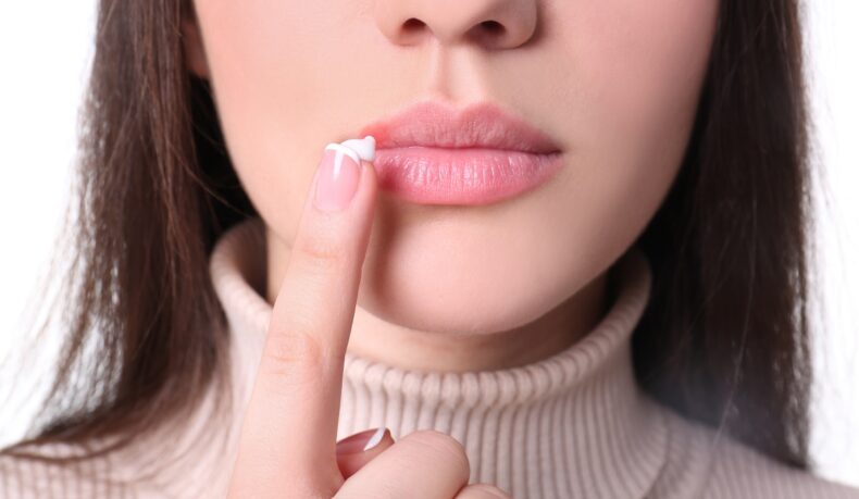 Femeie care dă cu cremă pe un herpes la gură, pe buză, cremele antivirale fiind un Tratament rapid pentru herpesul la gură