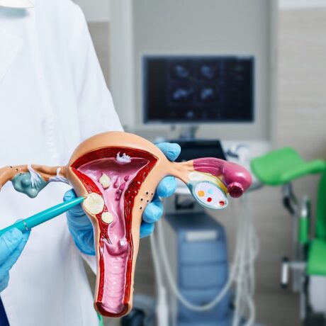 Doctor care prezintă fibromul uterin pe o machetă și pacientă în fundal, în cabinetul ginecologic