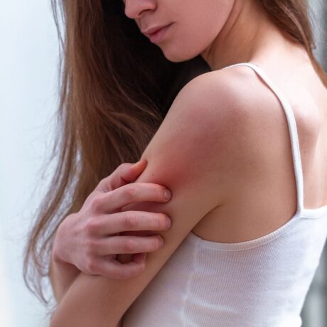 Femeie cu iritație pe piele care se scarpină, sugestiv pentru cum se manifestă scabia