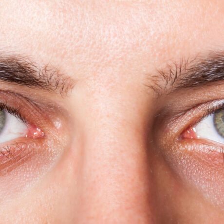 Un bărbat tânăr cu iritație la nivelul ochilor