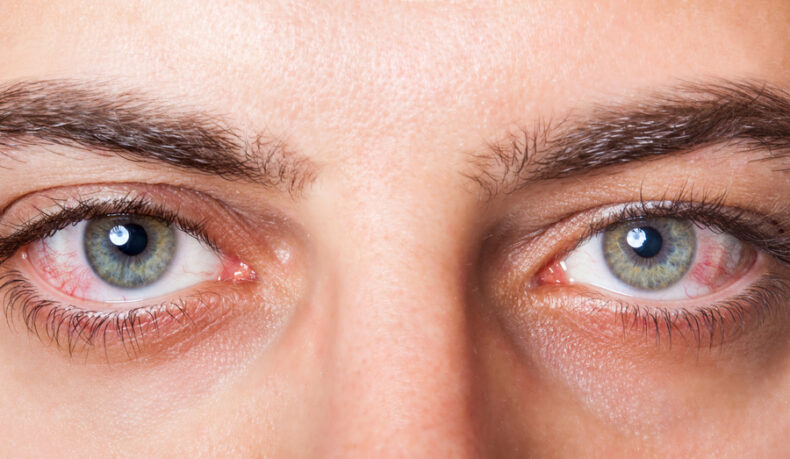 Cauze frecvente ale ochilor roșii. Ce poate indica acest simptom