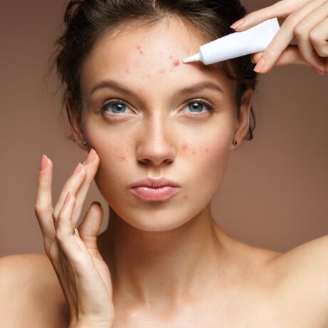 Femeie cu acnee pe frunte și cremă tratament pentru acneea hormonală